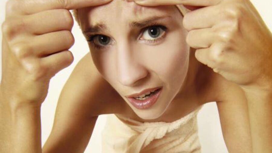 Tomás Caetano tem 31 anos e sofre de acne tardio 